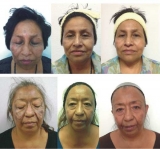 Melasma: tratamiento mesoter�pico con �cido tranex�mico al 5%