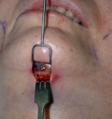 Est�tica del ment�n: una cirug�a sencilla y con buenos resultados