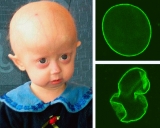 Progeria: sorprendente hallazgo cient�fico podr�a ser clave para frenar el paso del tiempo