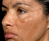 Los cloasmas: una reacci�n a las hormonas