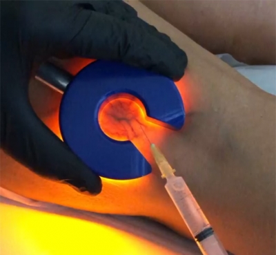 Escleroterapia por transiluminaci�n, ideal para eliminar venas varicosas